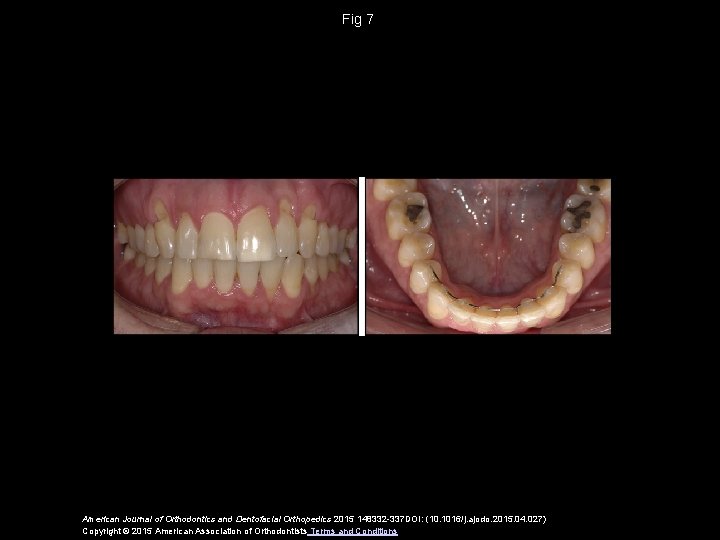 Fig 7 American Journal of Orthodontics and Dentofacial Orthopedics 2015 148332 -337 DOI: (10.