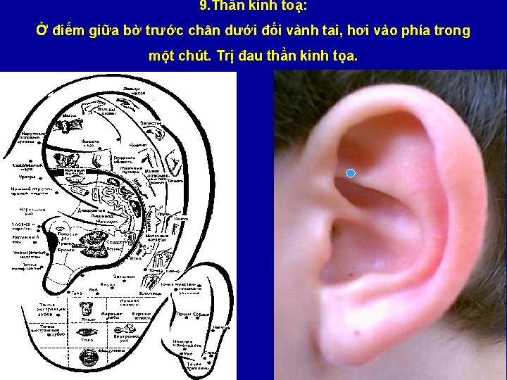 9. Thần kinh toạ: Ở điểm giữa bờ trước chân dưới đối vành tai,