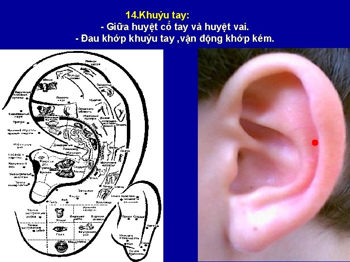 14. Khuỷu tay: - Giữa huyệt cổ tay và huyệt vai. - Đau khớp