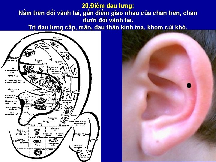 20. Điểm đau lưng: Nằm trên đối vành tai, gần điểm giao nhau của