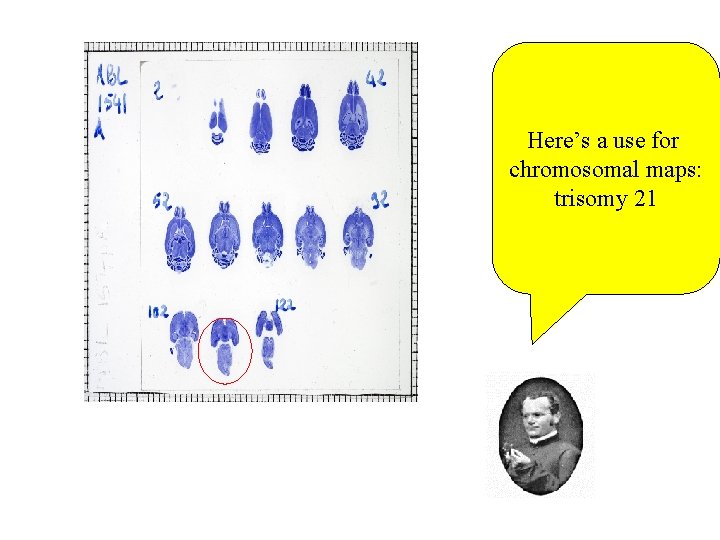 Here’s a use for chromosomal maps: trisomy 21 