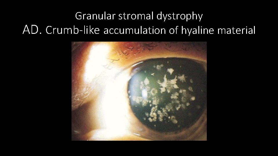 Granular stromal dystrophy AD. Crumb-like accumulation of hyaline material 