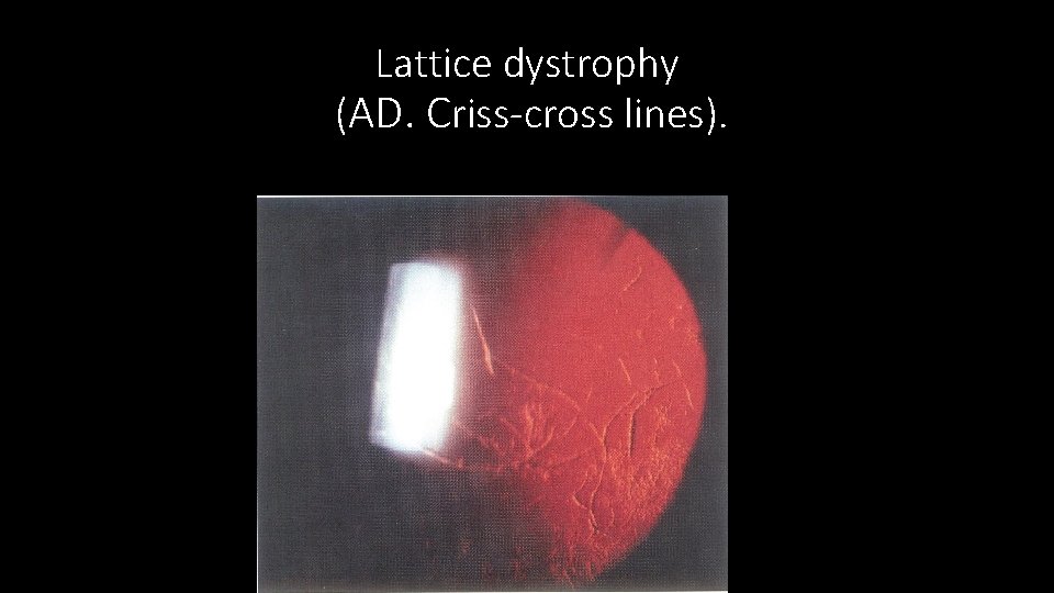 Lattice dystrophy (AD. Criss-cross lines). 