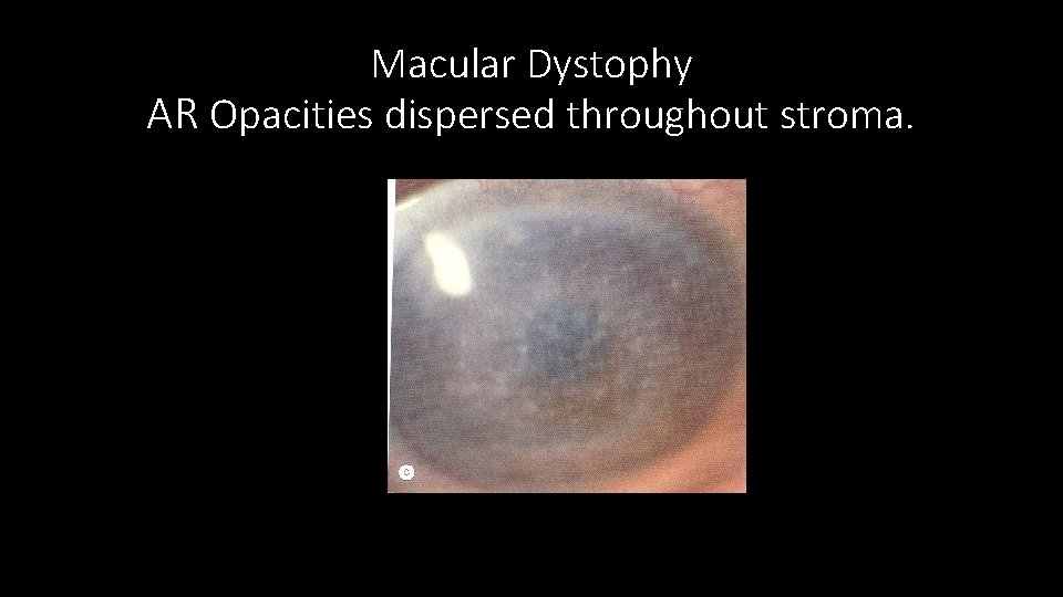 Macular Dystophy AR Opacities dispersed throughout stroma. 