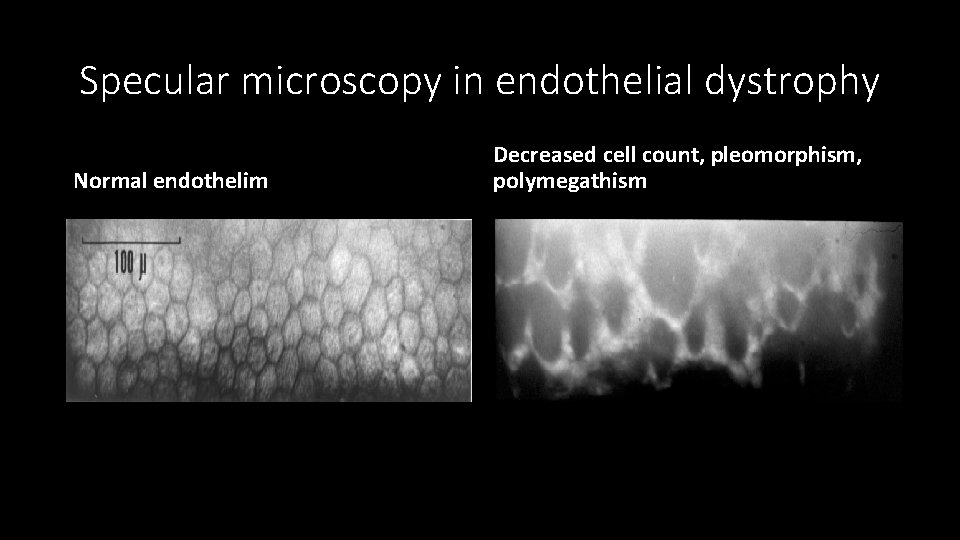 Specular microscopy in endothelial dystrophy Normal endothelim Decreased cell count, pleomorphism, polymegathism 