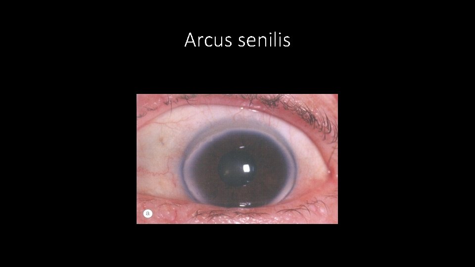 Arcus senilis 