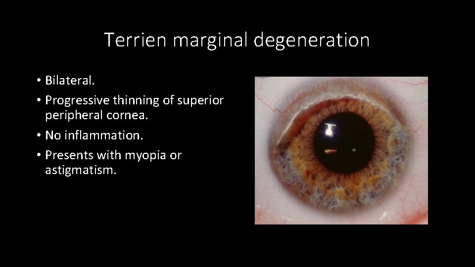 Terrien marginal degeneration • Bilateral. • Progressive thinning of superior peripheral cornea. • No