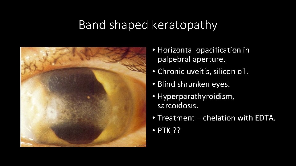 Band shaped keratopathy • Horizontal opacification in palpebral aperture. • Chronic uveitis, silicon oil.