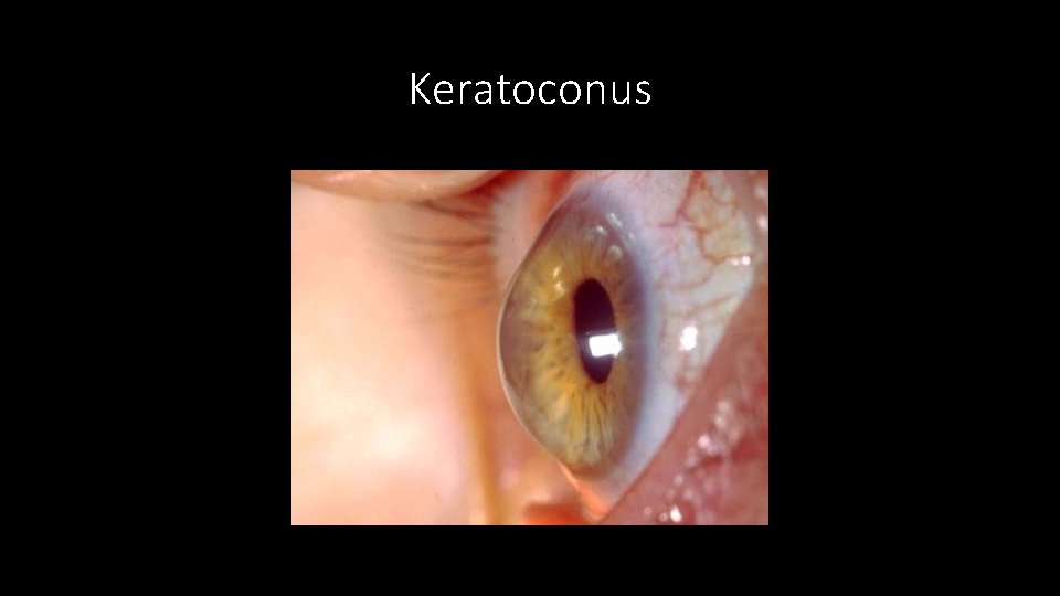 Keratoconus 