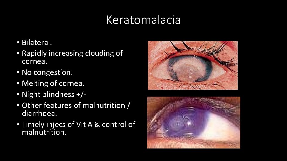Keratomalacia • Bilateral. • Rapidly increasing clouding of cornea. • No congestion. • Melting