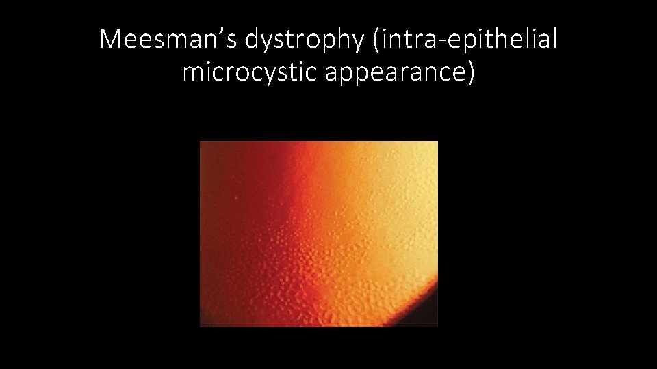 Meesman’s dystrophy (intra-epithelial microcystic appearance) 