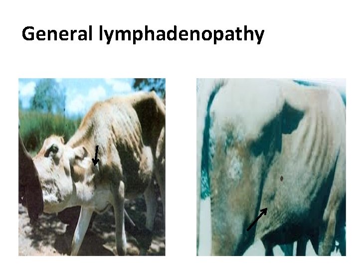 General lymphadenopathy 