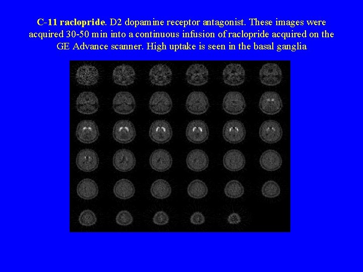 C-11 raclopride. D 2 dopamine receptor antagonist. These images were acquired 30 -50 min
