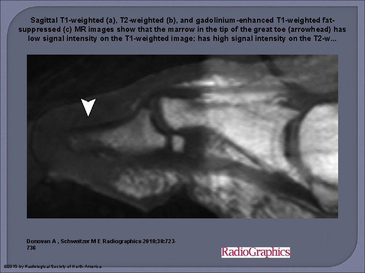 Sagittal T 1 -weighted (a), T 2 -weighted (b), and gadolinium-enhanced T 1 -weighted