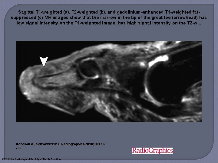 Sagittal T 1 -weighted (a), T 2 -weighted (b), and gadolinium-enhanced T 1 -weighted