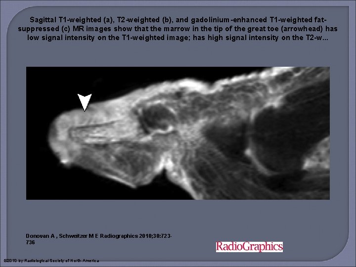 Sagittal T 1 -weighted (a), T 2 -weighted (b), and gadolinium-enhanced T 1 -weighted