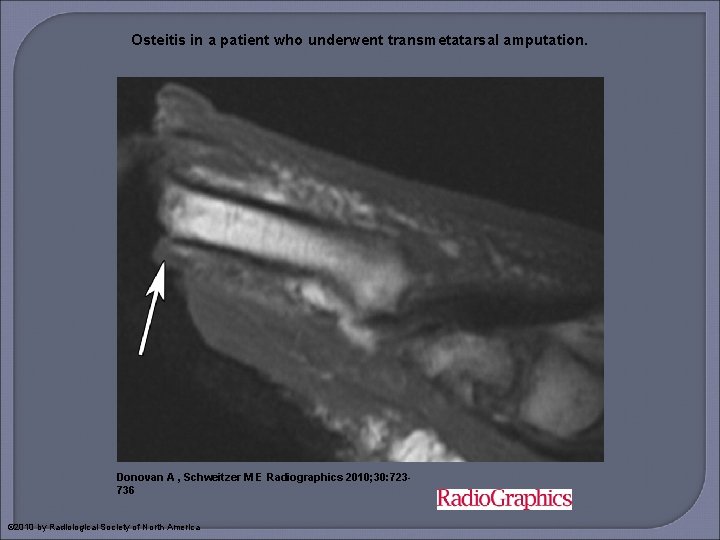 Osteitis in a patient who underwent transmetatarsal amputation. Donovan A , Schweitzer M E