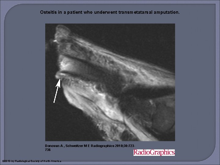 Osteitis in a patient who underwent transmetatarsal amputation. Donovan A , Schweitzer M E