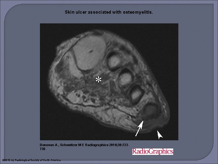 Skin ulcer associated with osteomyelitis. Donovan A , Schweitzer M E Radiographics 2010; 30: