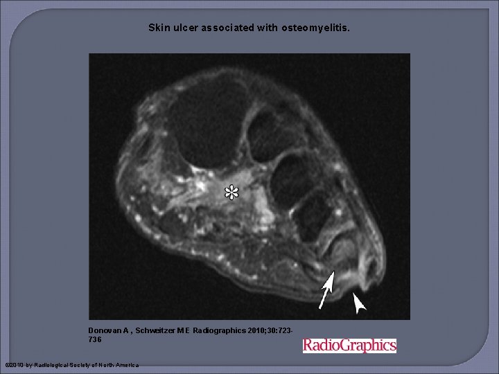 Skin ulcer associated with osteomyelitis. Donovan A , Schweitzer M E Radiographics 2010; 30: