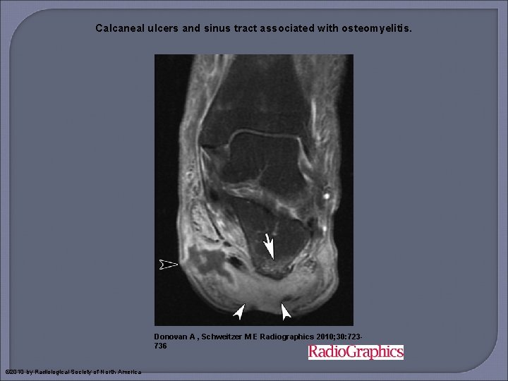 Calcaneal ulcers and sinus tract associated with osteomyelitis. Donovan A , Schweitzer M E