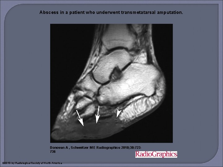 Abscess in a patient who underwent transmetatarsal amputation. Donovan A , Schweitzer M E