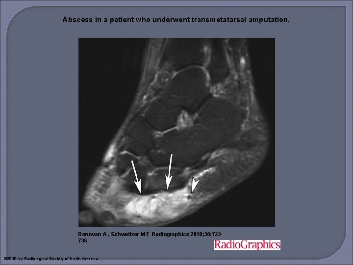 Abscess in a patient who underwent transmetatarsal amputation. Donovan A , Schweitzer M E