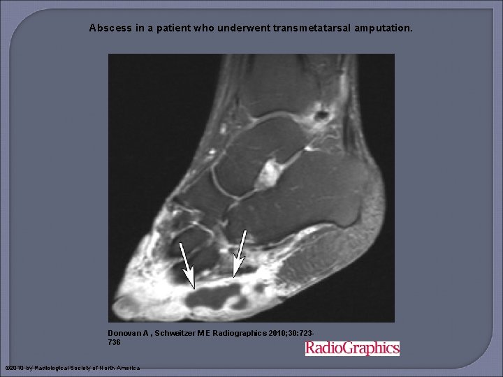 Abscess in a patient who underwent transmetatarsal amputation. Donovan A , Schweitzer M E