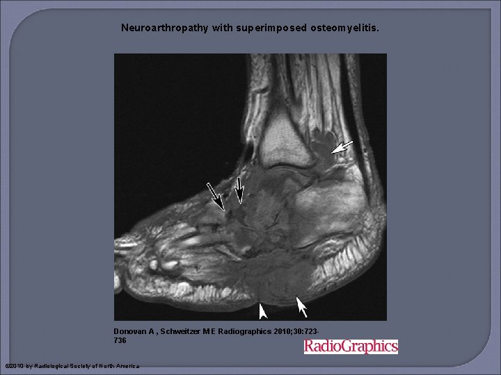 Neuroarthropathy with superimposed osteomyelitis. Donovan A , Schweitzer M E Radiographics 2010; 30: 723736