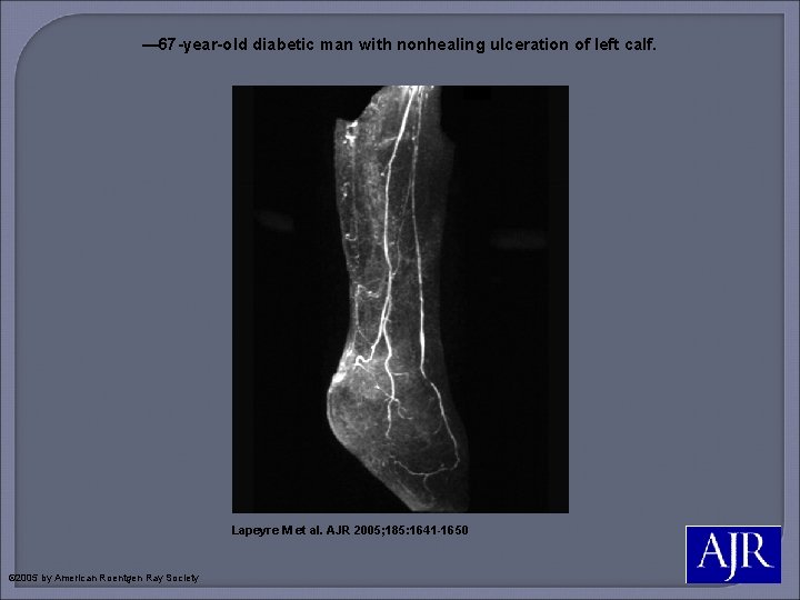 — 67 -year-old diabetic man with nonhealing ulceration of left calf. Lapeyre M et