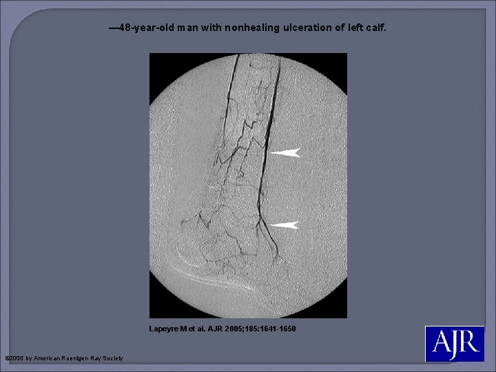 — 48 -year-old man with nonhealing ulceration of left calf. Lapeyre M et al.