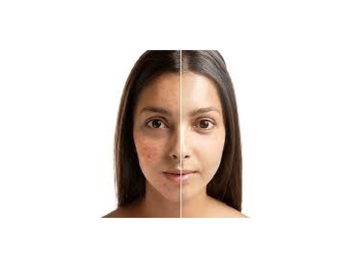 Blue Light Acne Treatment Acne Removal Treatment Clinic