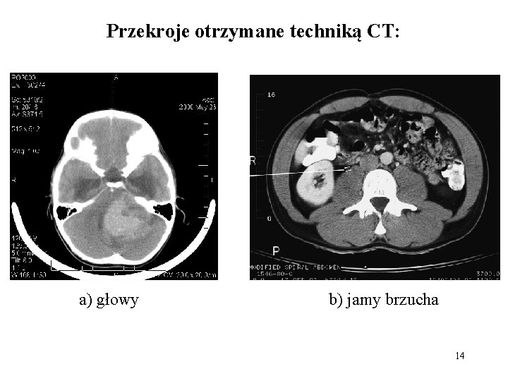 Przekroje otrzymane techniką CT: a) głowy b) jamy brzucha 14 