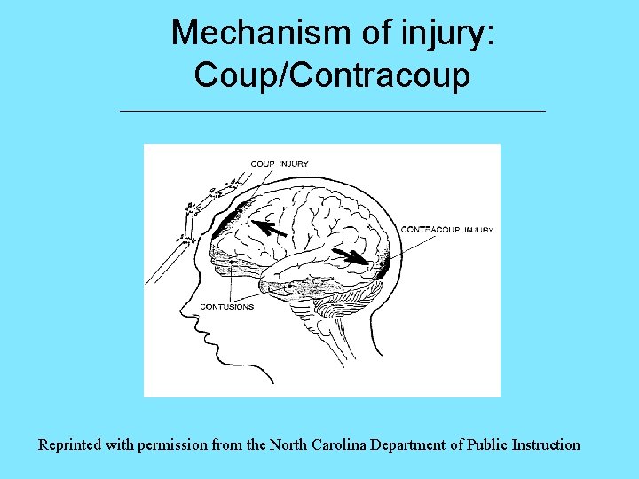 Mechanism of injury: Coup/Contracoup ___________________________ Reprinted with permission from the North Carolina Department of