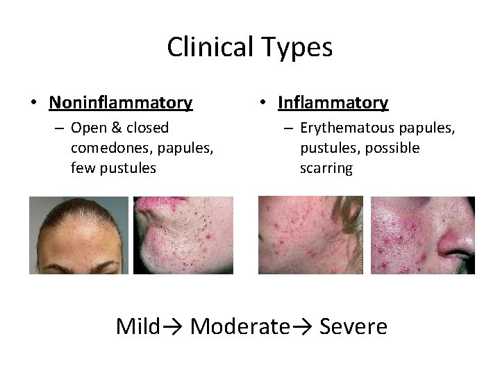 Clinical Types • Noninflammatory – Open & closed comedones, papules, few pustules • Inflammatory