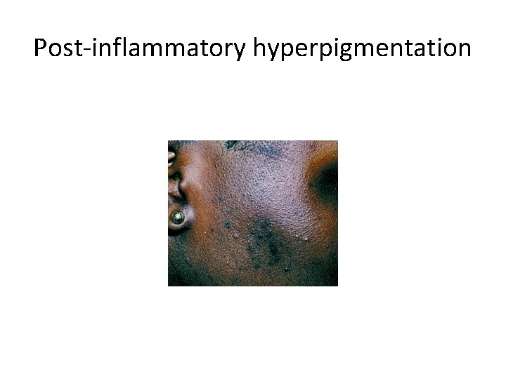 Post-inflammatory hyperpigmentation 