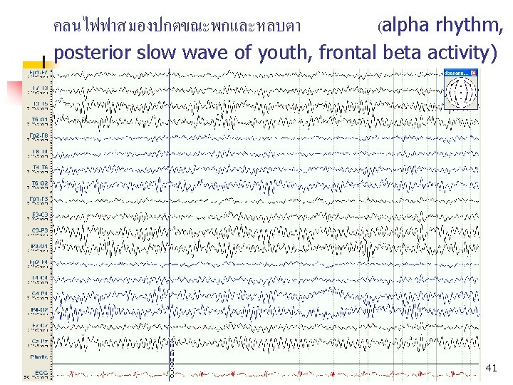 คลนไฟฟาสมองปกตขณะพกและหลบตา (alpha rhythm, posterior slow wave of youth, frontal beta activity) Normal EEG in