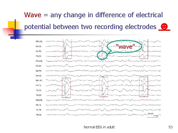 Wave = any change in difference of electrical potential between two recording electrodes ☻