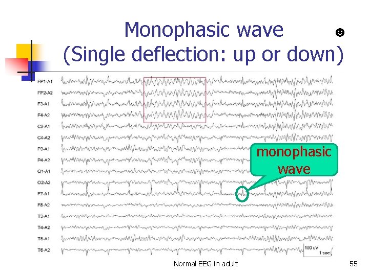 ☻ Monophasic wave (Single deflection: up or down) monophasic wave Normal EEG in adult