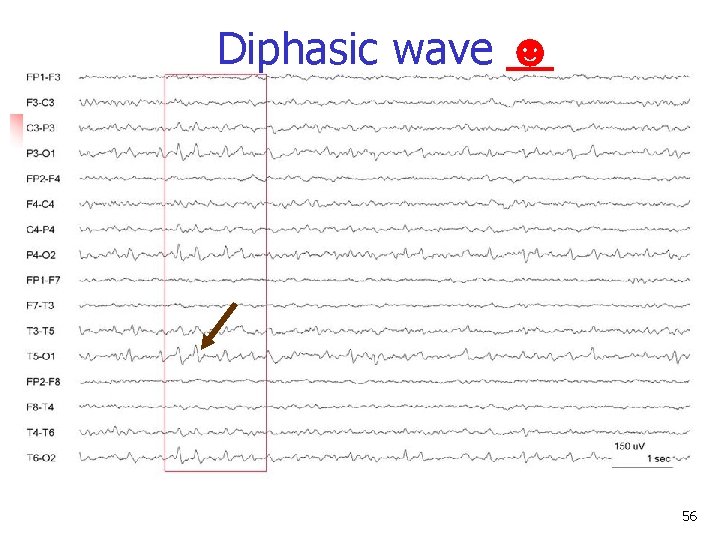 Diphasic wave ☻ Diphasic wave 56 