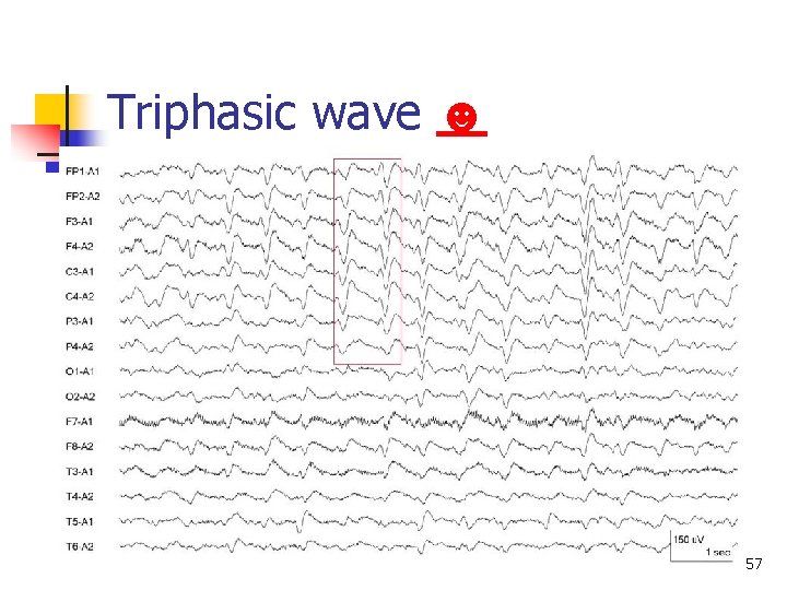 Triphasic wave ☻ 57 