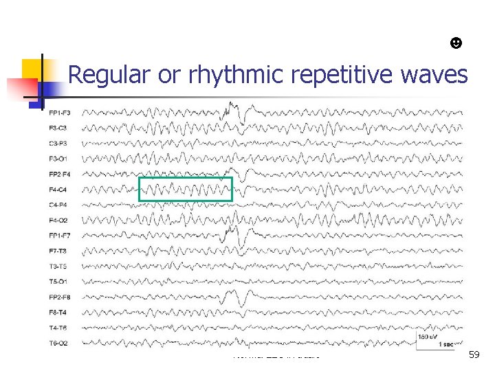 ☻ Regular or rhythmic repetitive waves Normal EEG in adult 59 