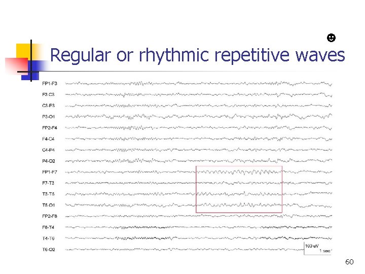 ☻ Regular or rhythmic repetitive waves Normal EEG in adult 60 
