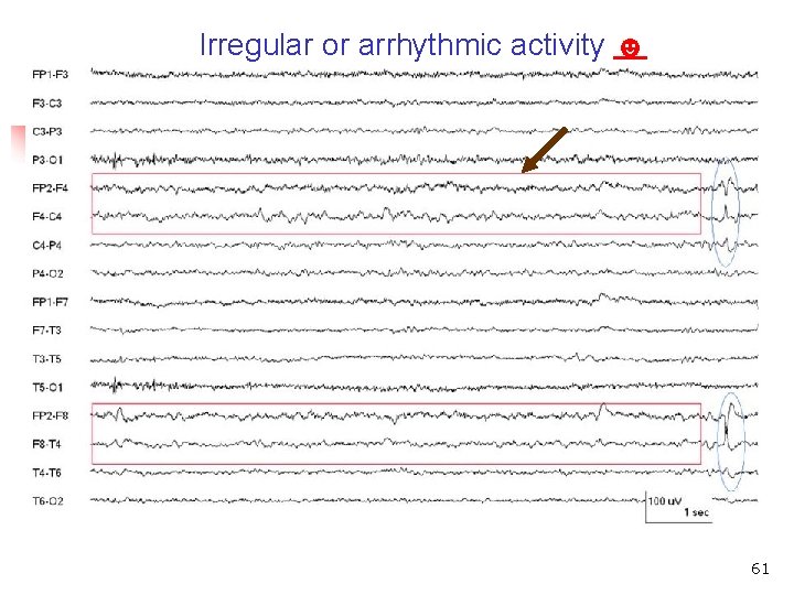 Irregular or arrhythmic activity ☻ Irregular or arrhythmic repetitive waves 61 