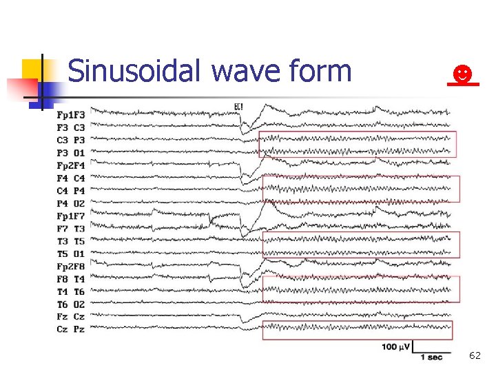 Sinusoidal wave form Normal EEG in adult ☻ 62 