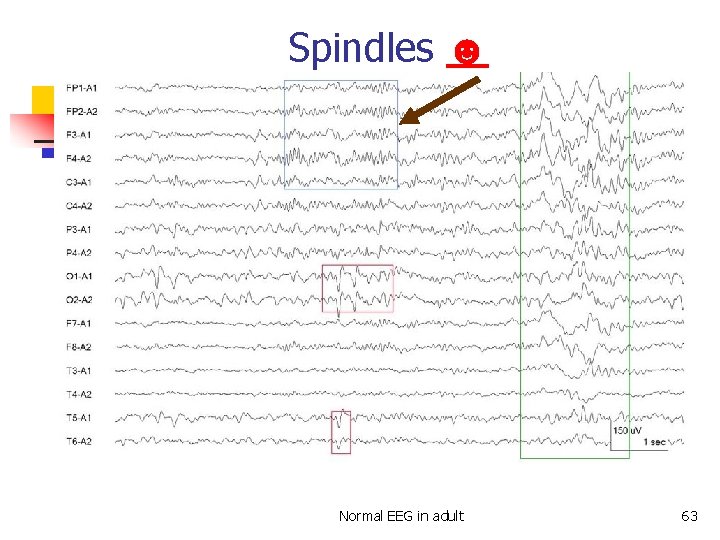 Spindles ☻ Spindles Normal EEG in adult 63 