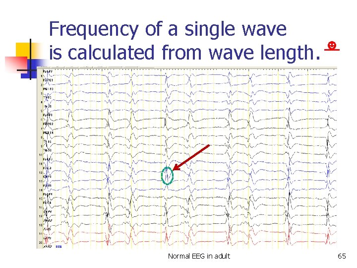 Frequency of a single wave ☻ is calculated from wave length. Normal EEG in