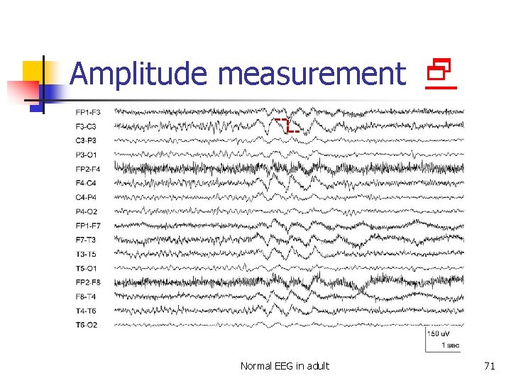 Amplitude measurement Normal EEG in adult 71 