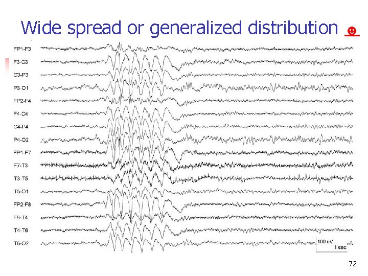 Wide spread or generalized distribution ☻ 72 