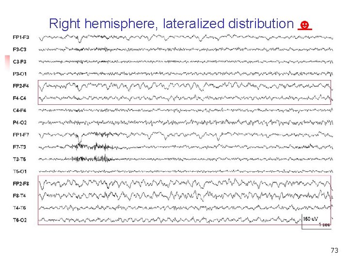 Right hemisphere, lateralized distribution ☻ Lateralized distribution 73 